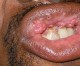 Infection orale avec le VPH: les hommes sont les plus touchés